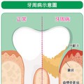 牙齒不健康 心血管疾病跟著來！