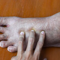 運匠香港腳沒看醫生，小腿紅腫像隻豬腳，竟是1疾病上身，嚴重恐截肢