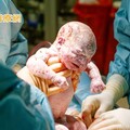 剖腹產同時切除卵巢 英國4名婦女接受突破性「二合一手術」