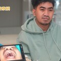 台灣義診團至菲律賓為顱顏缺陷患者診治 27歲男修復腭裂食物不再從鼻流出