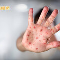 【闢謠】感染麻疹可獲抗體！？ 輕忽恐釀重症與嚴重併發症