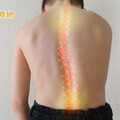 脊椎側彎中醫怎麼治療？ 針灸、用藥、復健三管齊下