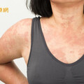 全身起皮疹又紅又癢以為蕁麻疹 就醫一驗竟是甲狀腺有問題
