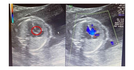胎兒法洛氏心臟病有4項特徵！胎兒心臟超音波是揪出法洛氏最後防線