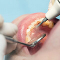 牙齦發炎、牙鬆咬不動快就醫！牙醫警告「這4症狀」恐是牙周病作祟