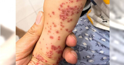「同學染腸病毒」女兒被停課…家長怨「長一點點疹子」：有那麼嚴重嗎？ 醫曬一照全網炸鍋