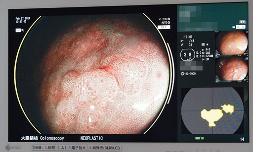 聖馬爾定醫院運用AI內視鏡檢查 大腸癌無所遁形