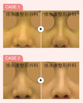 新式韓式隆鼻術，打造美形俏鼻有一套