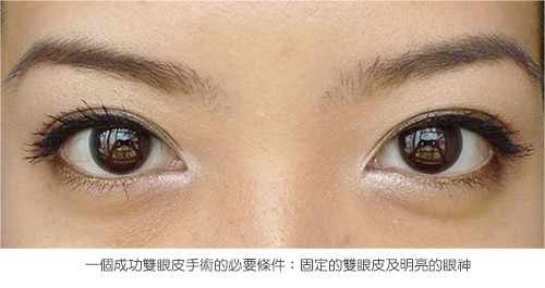 3D雙眼皮成形手術