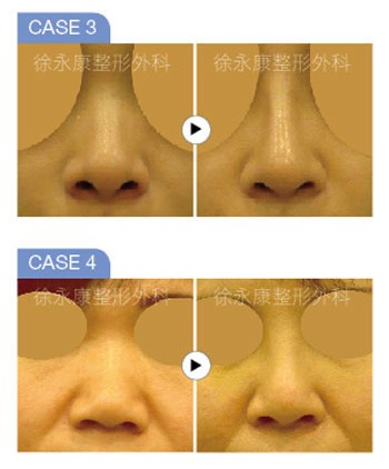 3D日式隆鼻 擬真美鼻創造術