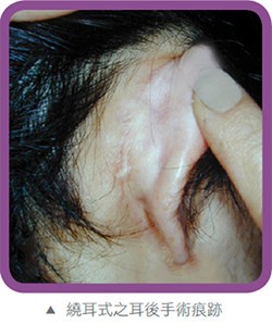 繞耳一周式之隱藏疤痕拉皮術