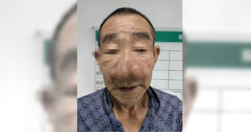 鼻頭反覆感染20年未就醫…老人鼻子「腫成鵝蛋」 輕輕一壓狂噴膿