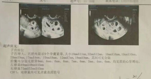 25歲女結婚1年沒懷孕…注射排卵藥物有喜了 產檢驚見「9胞胎」傻眼