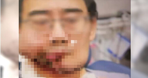 38歲男罹口腔癌…砸180萬治病「半張臉消失」 輕信好友下場慘了