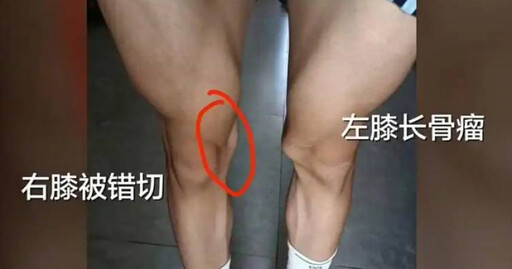 17歲體育生左膝長骨瘤！醫生竟「錯切右膝」 母親發聲：不接受和解