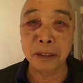 7旬翁出門散步被拉去割眼袋！女兒衝診所接人「來不及了」 負責人回應