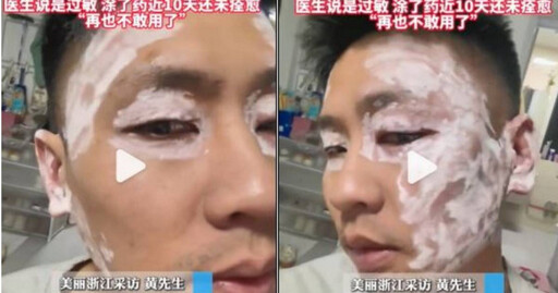餐廳紙巾有毒? 陸男擦完臉「腫成豬臉」險毀容:再也不敢了
