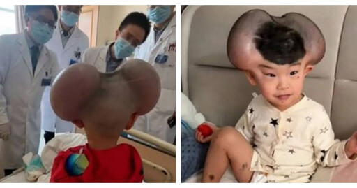 3歲男童罹巨痣遭嘲「米老鼠」 5個月手術後重拾笑容