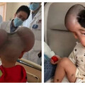 3歲男童罹巨痣遭嘲「米老鼠」 5個月手術後重拾笑容