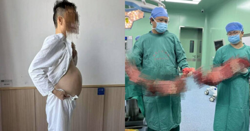 便秘4個月沒排便!他腹部腫大「如懷胎10月」 開刀取出10公斤重壞死結腸