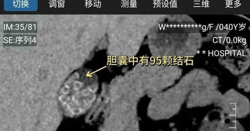 40歲女腹痛送醫！一開刀醫傻眼 膽囊塞滿95顆結石