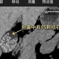 40歲女腹痛送醫！一開刀醫傻眼 膽囊塞滿95顆結石