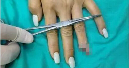 手被門夾到!陸女不知手指頭斷了…竟是「美甲太厚」害觸覺失靈