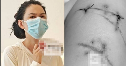 妙齡女逛街遭陌生人挾持「狂捅22刀」 靠隆乳假體撿回一命