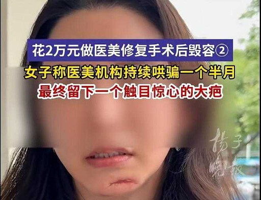 南京女臉部脂肪填充失敗 修復手術險毀容「留6公分疤痕」
