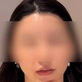 南京女臉部脂肪填充失敗 修復手術險毀容「留6公分疤痕」