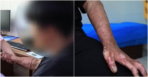 陸青少年瘋吸打火機!18歲男不慎引爆「手指終生伸不直」悔喊:後半生毀了