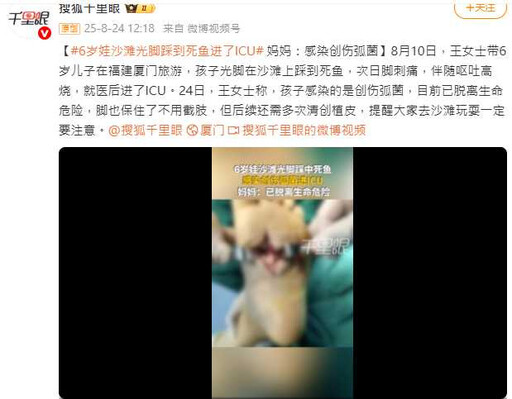6歲童沙灘赤腳踩死魚 感染「海洋無聲殺手」創傷弧菌險截肢