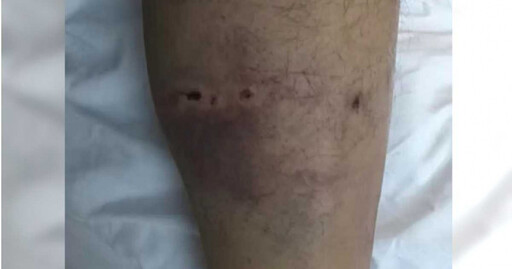 重慶男子上山採菇 遭黑熊襲擊「一巴掌打下山坡」！生還直呼：雨靴救我一命