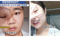 面部巨瘤壓迫左眼視力幾近全盲！28歲女子憂「生小孩恐讓腫瘤惡化」 決定一輩子不婚