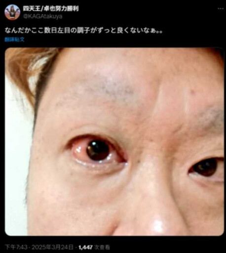 38歲日諧星腦幹梗塞猝逝 生前曾曬「左眼出血照」吐:狀況不太好