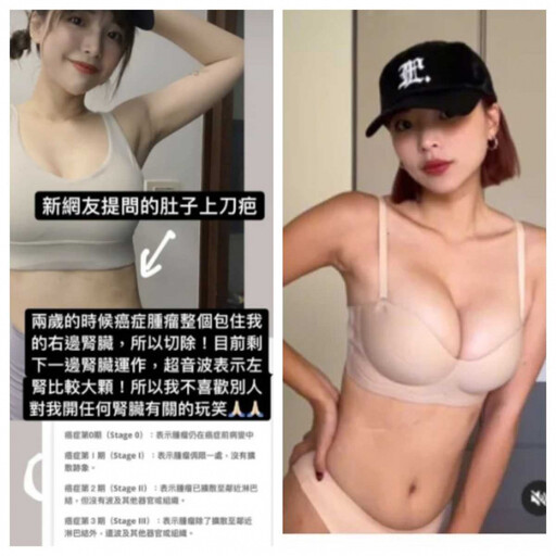 YouTuber一隻阿圓抗癌故事曝 2歲切除右腎「疤痕是活下來的證明」