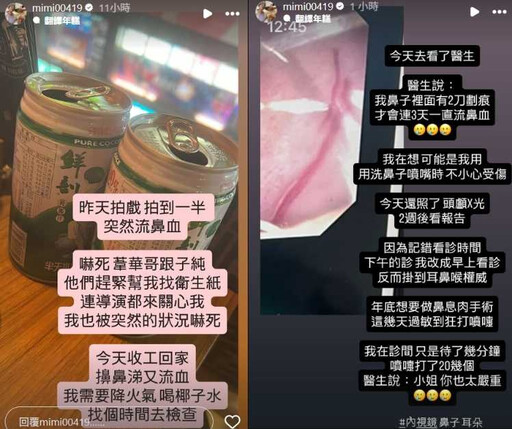 米可白連3天狂流鼻血 就醫檢查有2刀劃痕!1狀況醫驚呼:太嚴重