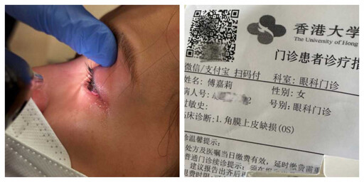只換件衣服竟割傷眼角膜!女星眼傷惡化痛到哭 醫:恐永久損傷