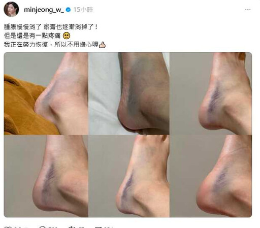 堅持跳完才送醫！南珉貞腳傷嚴重曝光 粉絲心疼喊快休息