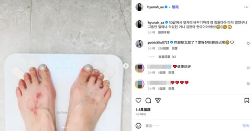 減肥後火速瘦回4字頭!泫雅腳背傷口引擔憂