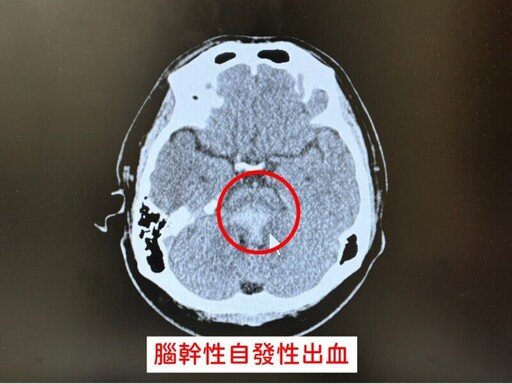 38歲男血壓高致腦幹自發性出血 全身癱瘓語言喪失