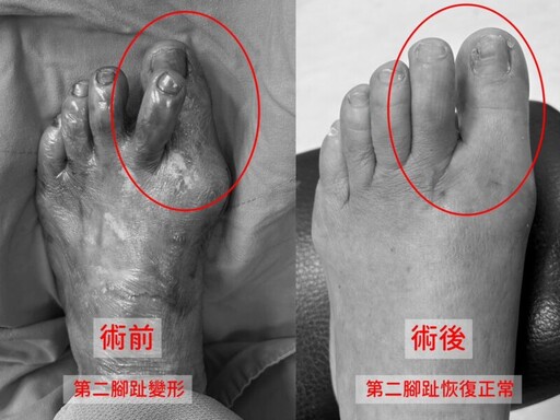 微創手術解決第二腳趾變形 ㄧ個月後恢復行走