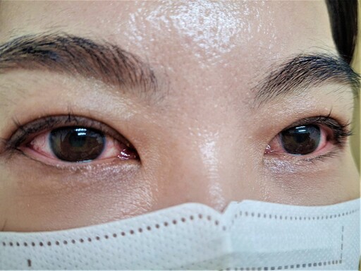 病毒性急性結膜炎 做好防護以防傳染快速擴散