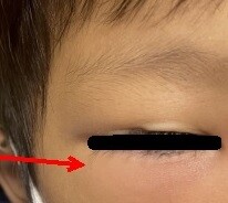 九歲童感冒竟併發嚴重感染 眼瞼腫得像麵龜