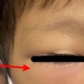 九歲童感冒竟併發嚴重感染 眼瞼腫得像麵龜