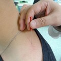 老翁肩頸硬梆梆 兩度腦梗塞、血壓睡眠雙失控