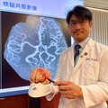 九歲女童腦中藏炸彈 中榮靜脈造影精準拆彈