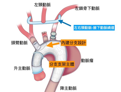 心臟手術新紀元 不開胸、心臟不停跳完成手術治療