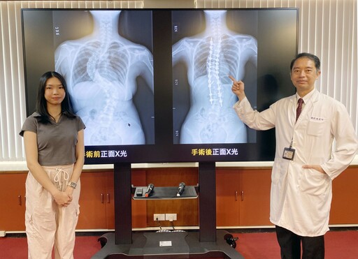 僑生脊椎像蜈蚣 台灣醫生神救援