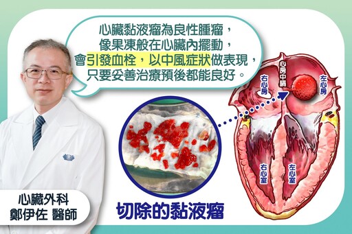 婦人中風竟是心臟作怪 心房內黏液瘤引發血栓